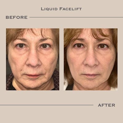 Dermal Fillers Before & After Gallery - Patient 119655 - Image 1