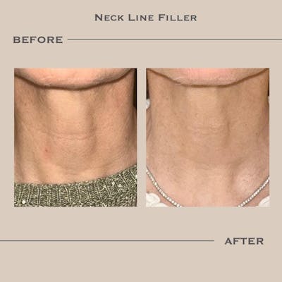 Dermal Fillers Before & After Gallery - Patient 321150 - Image 1
