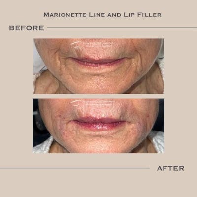 Lip Fillers Before & After Gallery - Patient 106256 - Image 1