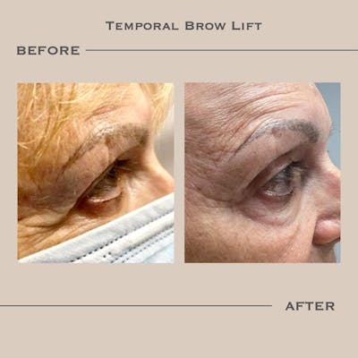 Brow Lift Before & After Gallery - Patient 361905 - Image 1