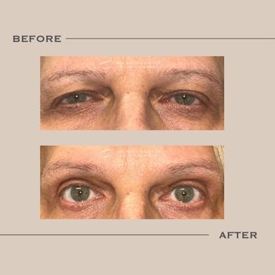 Ptosis  Before & After Gallery - Patient 419994 - Image 1
