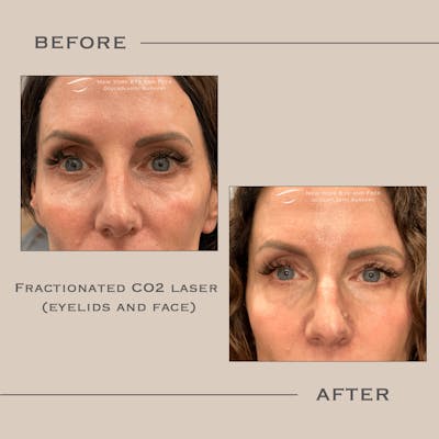 AcuPulse CO2 Laser Before & After Gallery - Patient 234538 - Image 1