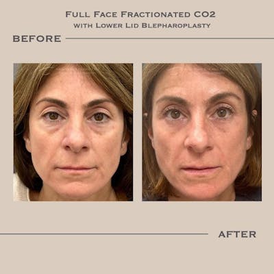 AcuPulse CO2 Laser Before & After Gallery - Patient 178314 - Image 1