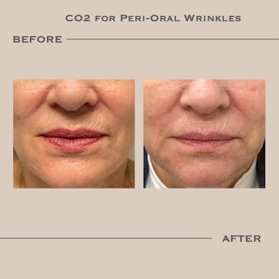 AcuPulse CO2 Laser Before & After Gallery - Patient 157050 - Image 1