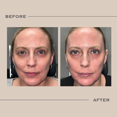 AcuPulse CO2 Laser Before & After Gallery - Patient 379994 - Image 1
