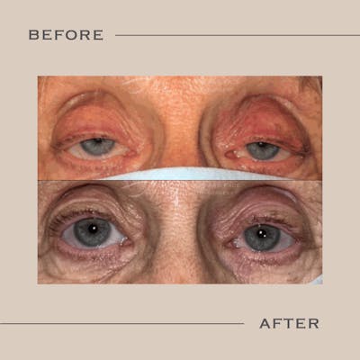 Ptosis  Before & After Gallery - Patient 333815 - Image 1