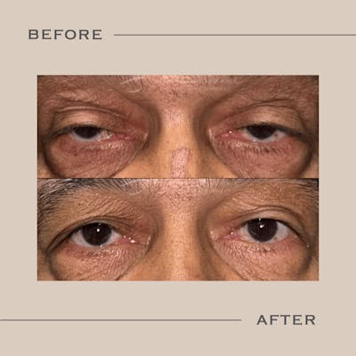 Ptosis  Before & After Gallery - Patient 195321 - Image 1