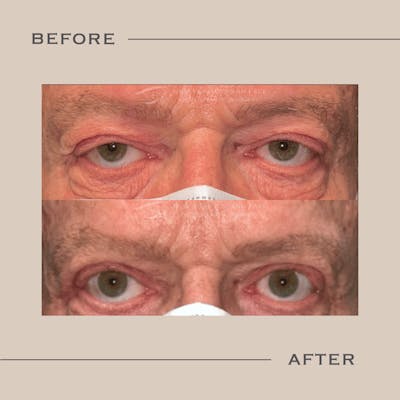 Ptosis  Before & After Gallery - Patient 320681 - Image 1