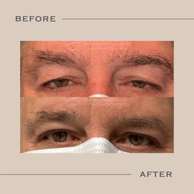 Ptosis  Before & After Gallery - Patient 174058 - Image 1