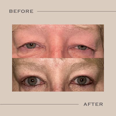Ptosis  Before & After Gallery - Patient 256652 - Image 1