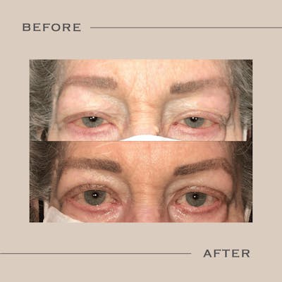 Ptosis  Before & After Gallery - Patient 293549 - Image 1