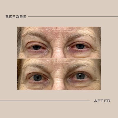 Ptosis  Before & After Gallery - Patient 337294 - Image 1