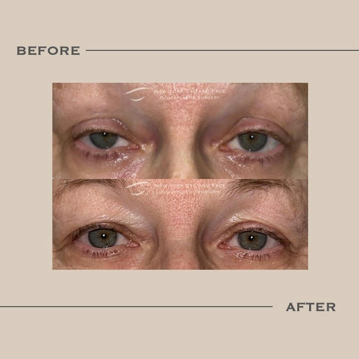 Ptosis  Before & After Gallery - Patient 128227 - Image 1