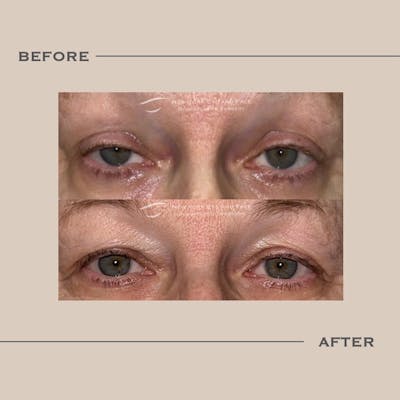 Ptosis  Before & After Gallery - Patient 128227 - Image 1