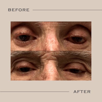 Entropion Before & After Gallery - Patient 388630 - Image 1