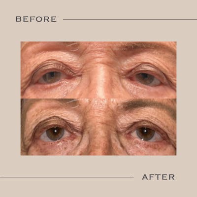 Entropion Before & After Gallery - Patient 829088 - Image 1