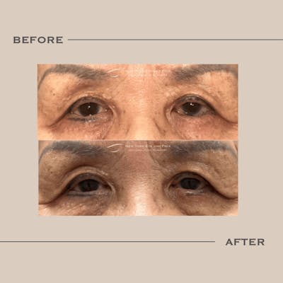 Entropion Before & After Gallery - Patient 354671 - Image 1