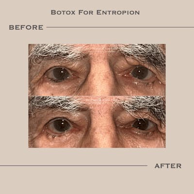 Entropion Before & After Gallery - Patient 315484 - Image 1