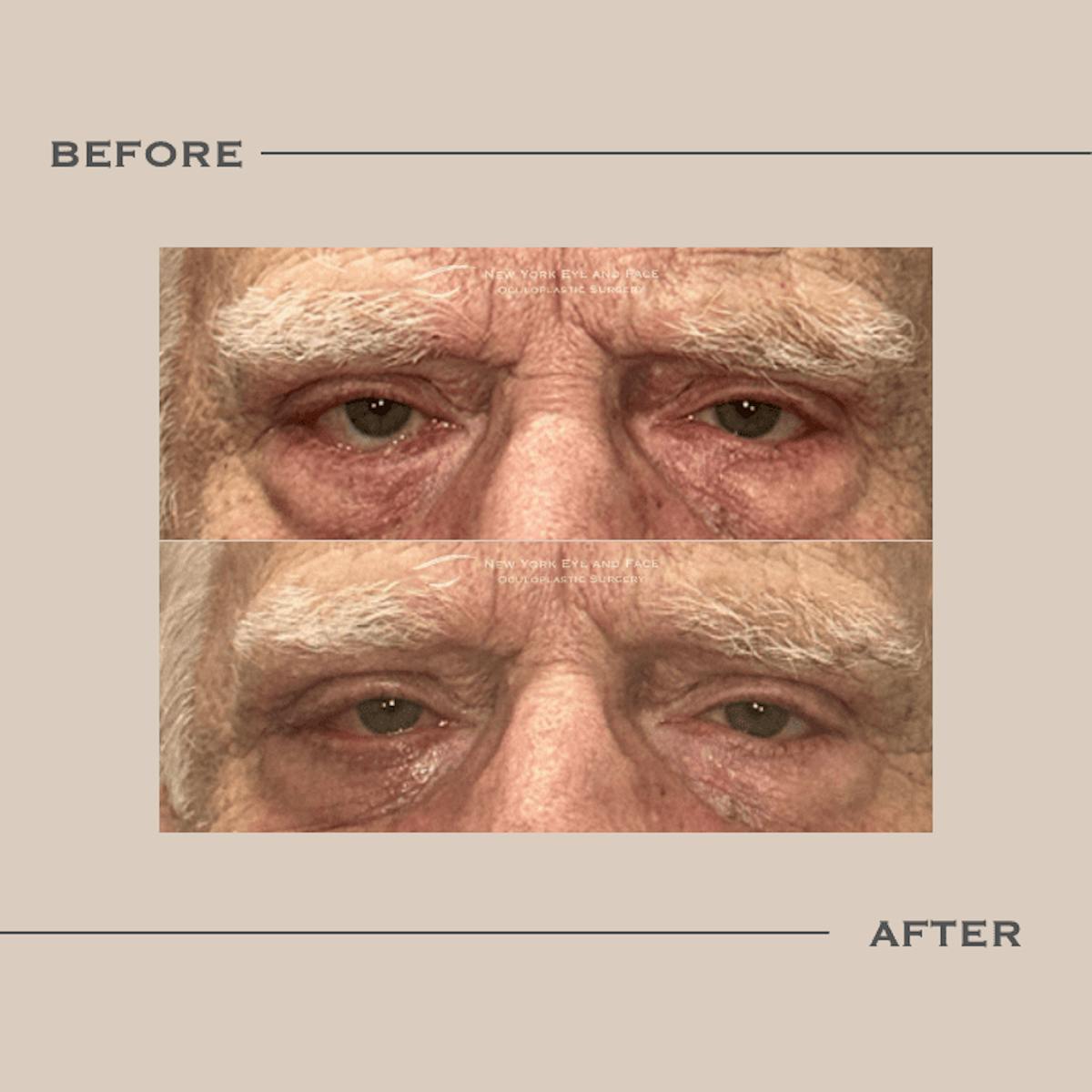 Entropion Before & After Gallery - Patient 390302 - Image 1