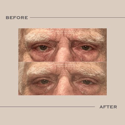 Entropion Before & After Gallery - Patient 390302 - Image 1