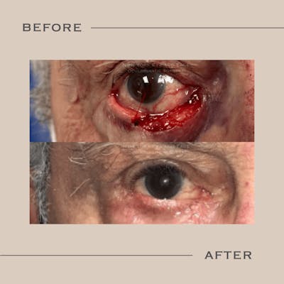 Skin Cancer Reconstruction Before & After Gallery - Patient 220367 - Image 1