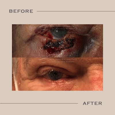 Skin Cancer Reconstruction Before & After Gallery - Patient 139259 - Image 1