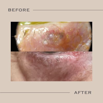 Skin Cancer Reconstruction Before & After Gallery - Patient 365806 - Image 1