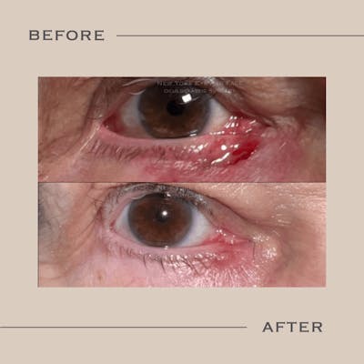 Skin Cancer Reconstruction Before & After Gallery - Patient 162162 - Image 1
