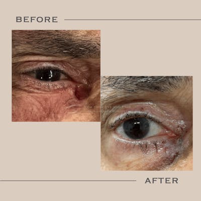 Skin Cancer Reconstruction Before & After Gallery - Patient 358615 - Image 1