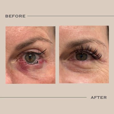 Skin Cancer Reconstruction Before & After Gallery - Patient 390165 - Image 1
