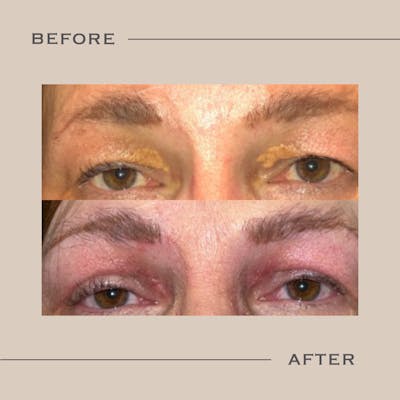 Xanthelasma Before & After Gallery - Patient 891425 - Image 1