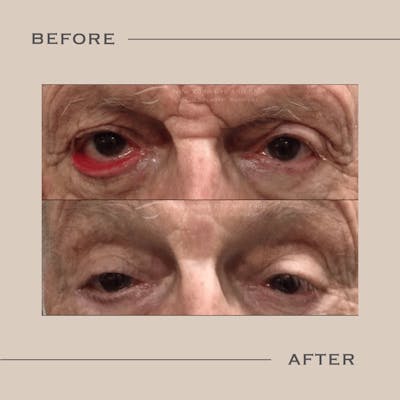 Ectropion Before & After Gallery - Patient 666658 - Image 1