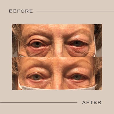 Ectropion Before & After Gallery - Patient 346828 - Image 1