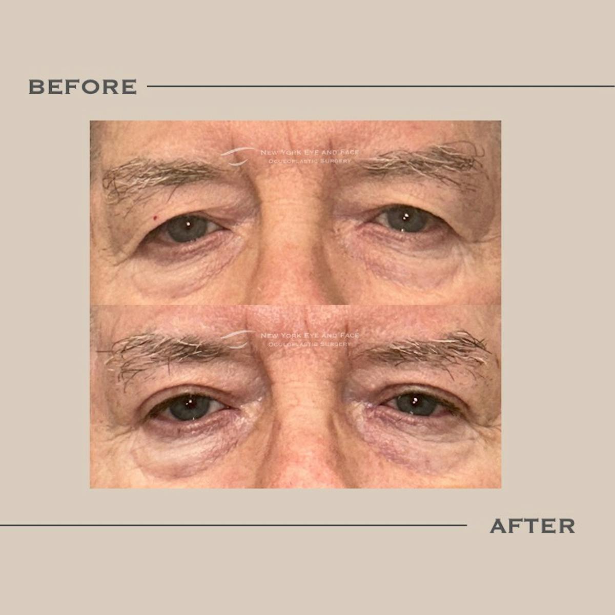 Upper Blepharoplasty Before & After Gallery - Patient 938421 - Image 1