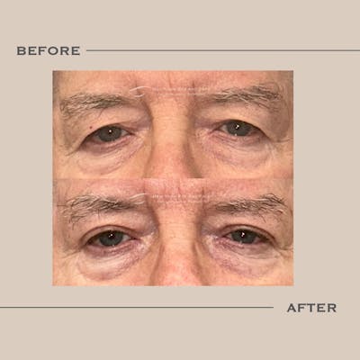 Upper Blepharoplasty Before & After Gallery - Patient 938421 - Image 1
