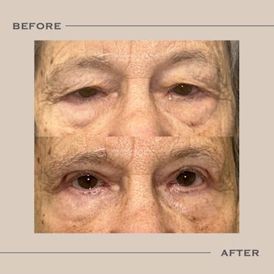 Upper Blepharoplasty Before & After Gallery - Patient 238284 - Image 1