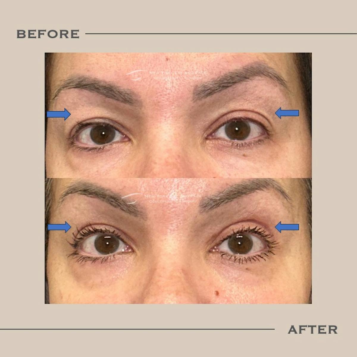 Upper Blepharoplasty Before & After Gallery - Patient 192667 - Image 1