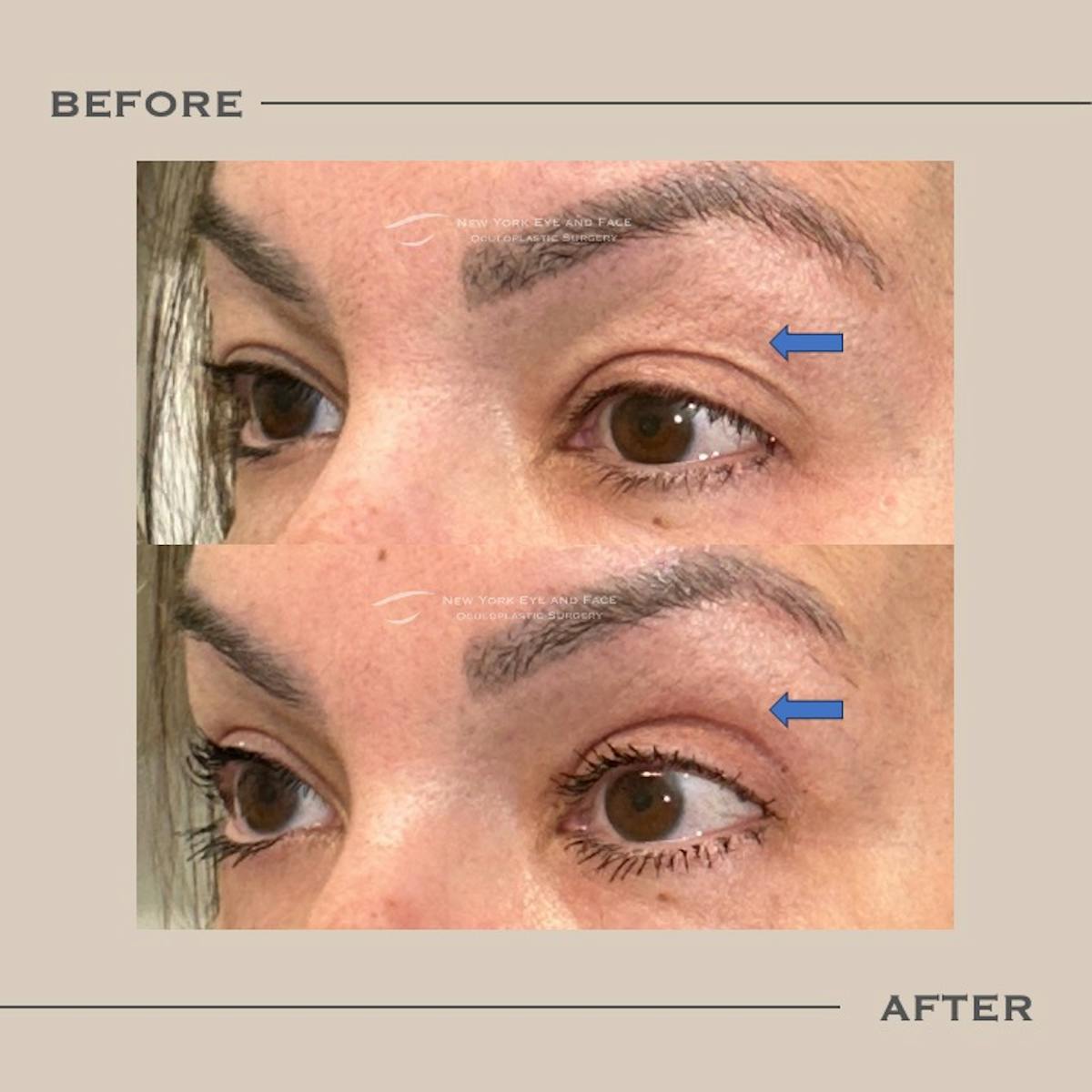 Upper Blepharoplasty Before & After Gallery - Patient 192667 - Image 2