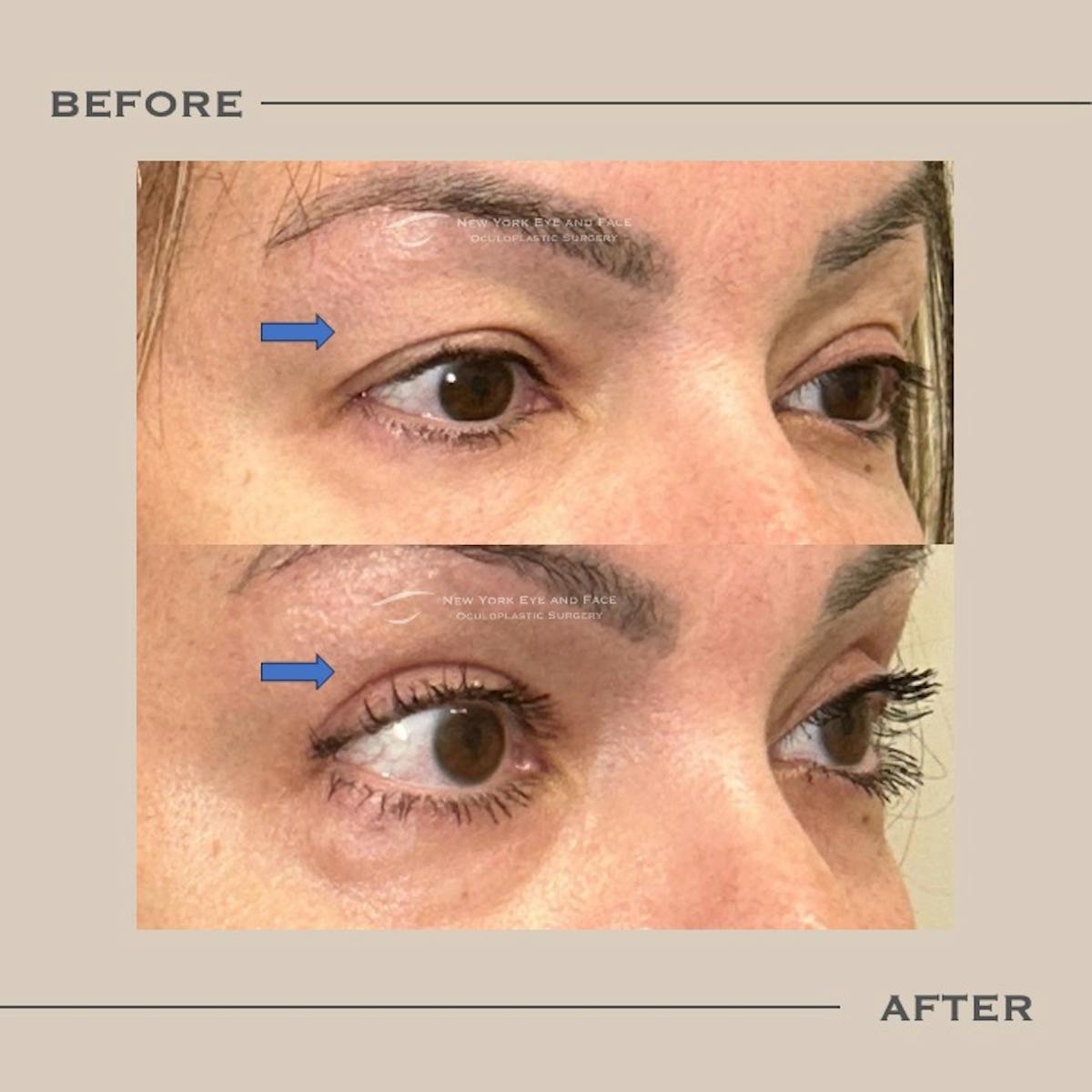 Upper Blepharoplasty Before & After Gallery - Patient 192667 - Image 3