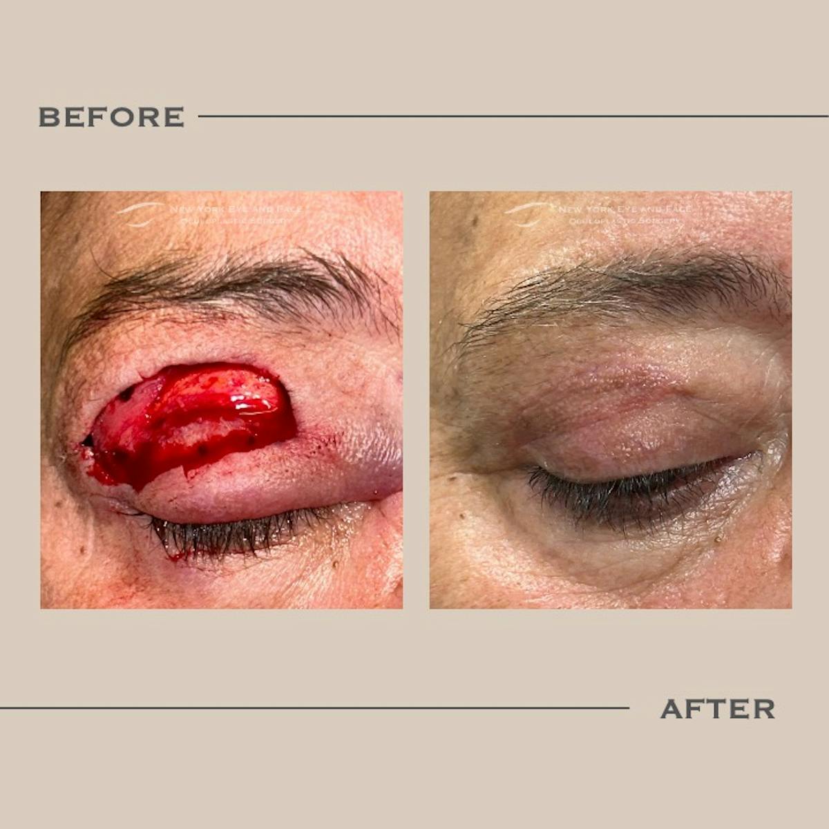 Skin Cancer Reconstruction Before & After Gallery - Patient 368123 - Image 1