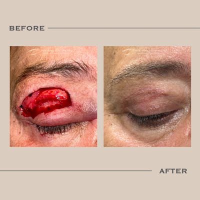 Skin Cancer Reconstruction Before & After Gallery - Patient 368123 - Image 1