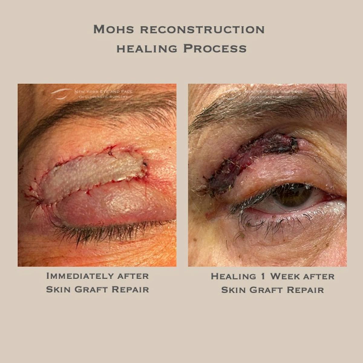 Skin Cancer Reconstruction Before & After Gallery - Patient 368123 - Image 2