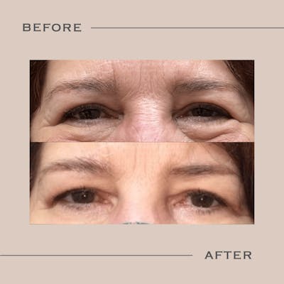 Upper Blepharoplasty Before & After Gallery - Patient 225127 - Image 1