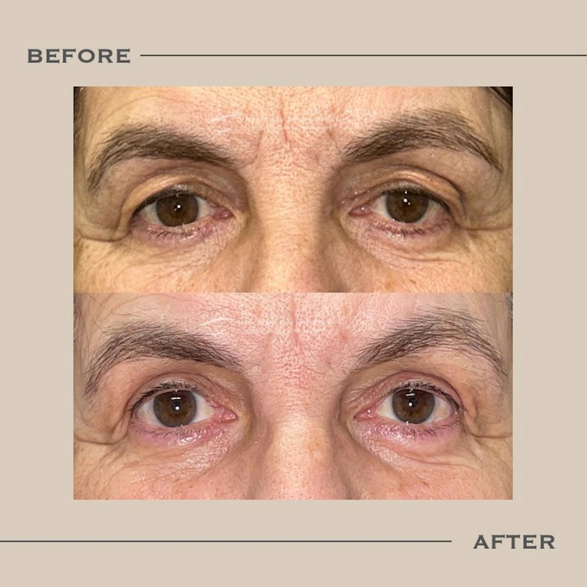 Upper Blepharoplasty Before & After Gallery - Patient 339041 - Image 1