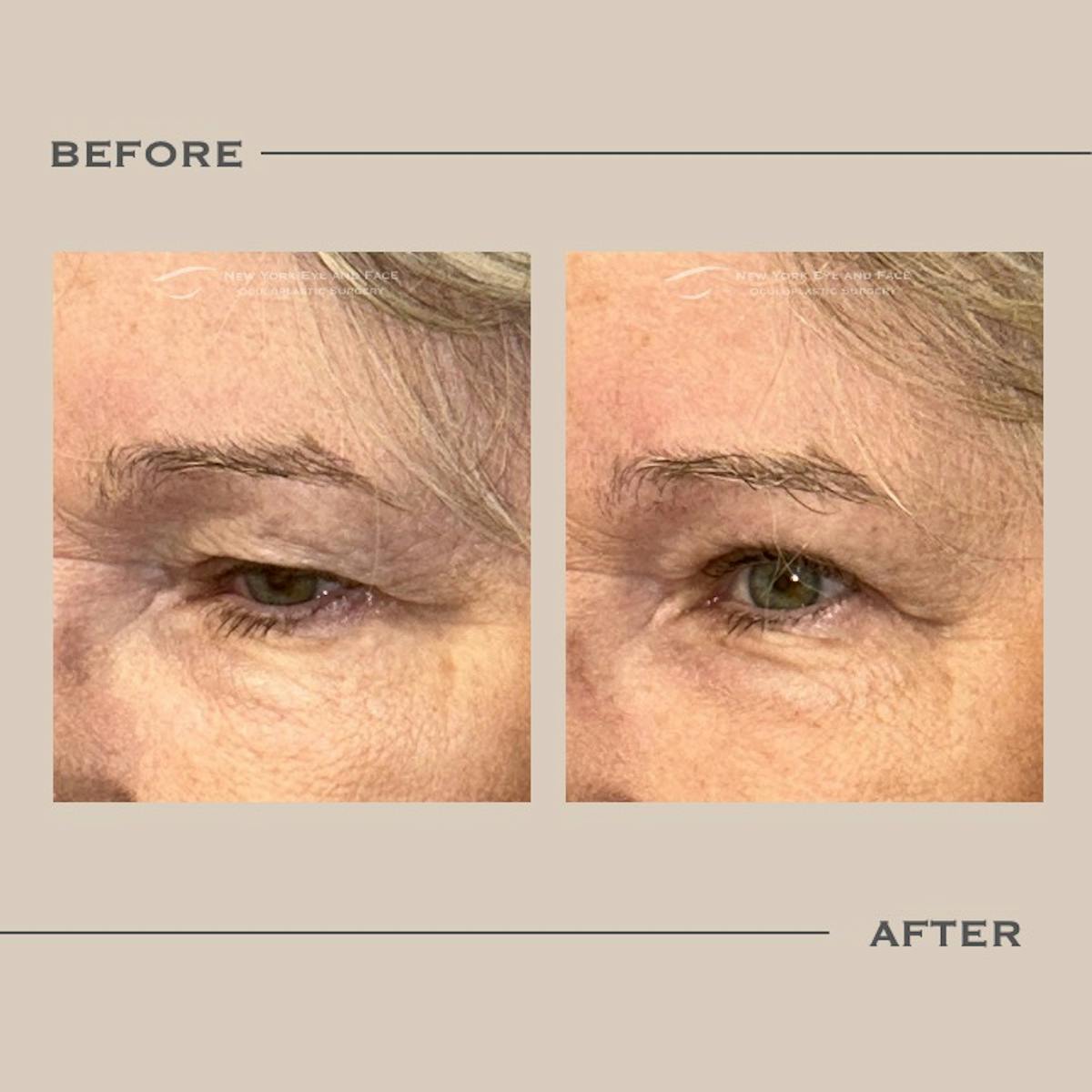 Upper Blepharoplasty Before & After Gallery - Patient 254984 - Image 2