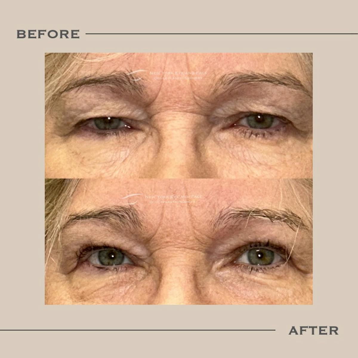 Upper Blepharoplasty Before & After Gallery - Patient 254984 - Image 1
