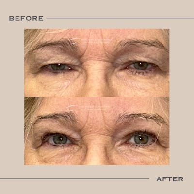 Upper Blepharoplasty Before & After Gallery - Patient 254984 - Image 1