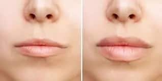 The Lip Flip: A Subtle Beauty Enhancement with Dr. Carniciu at NY Eye and Face