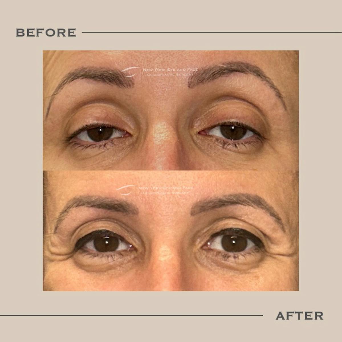 Ptosis  Before & After Gallery - Patient 338668 - Image 1