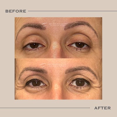 Ptosis  Before & After Gallery - Patient 338668 - Image 1